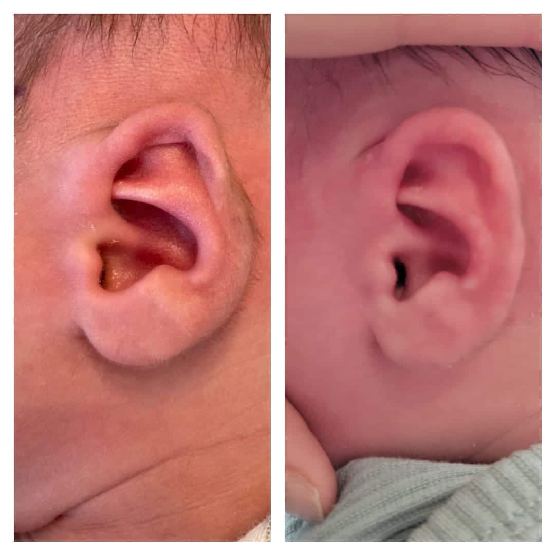 Treatment of prominent and constricted ear anomalies - Infant Ear